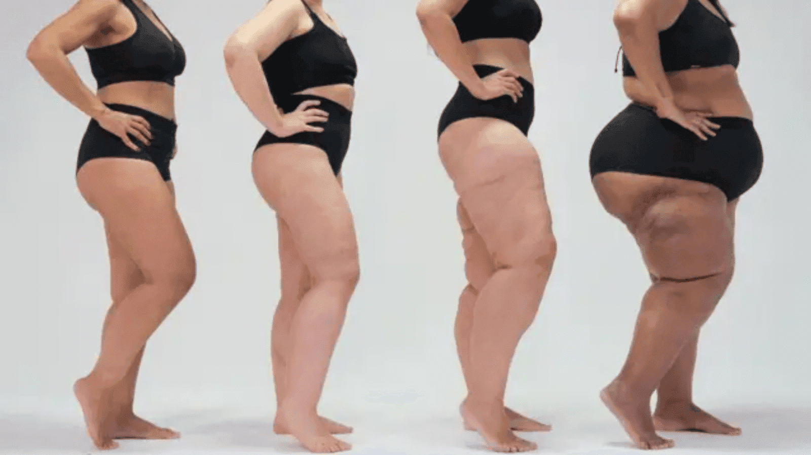 Lipedema Sintomas Diagnóstico e Tratamentos 2026